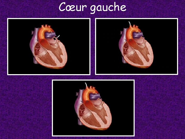 Cœur gauche 