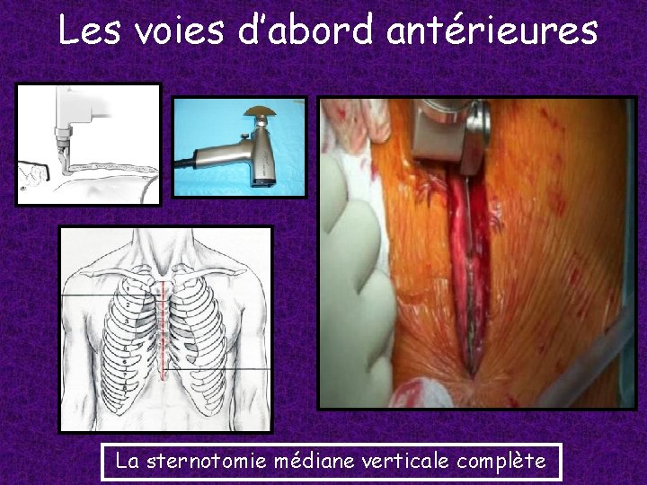 Les voies d’abord antérieures La sternotomie médiane verticale complète 
