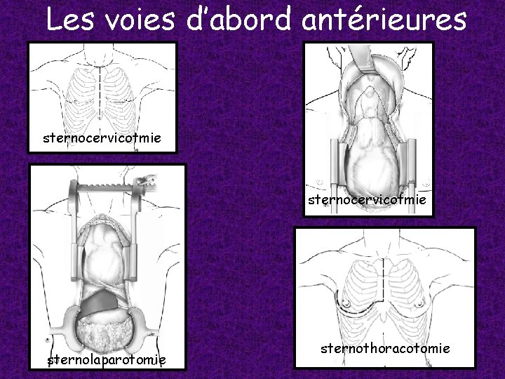 Les voies d’abord antérieures sternocervicotmie sternolaparotomie sternothoracotomie 
