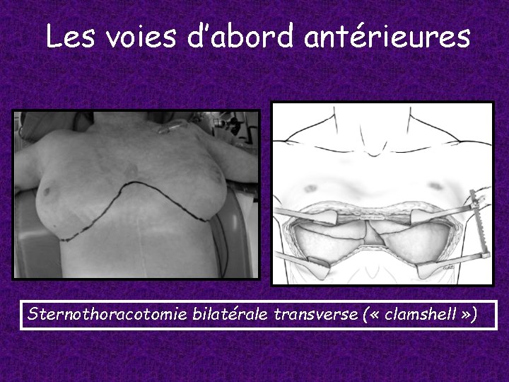 Les voies d’abord antérieures Sternothoracotomie bilatérale transverse ( « clamshell » ) 