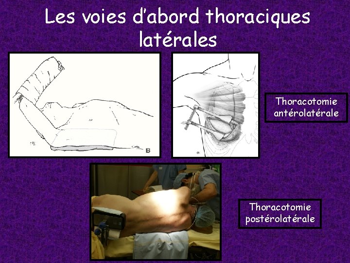 Les voies d’abord thoraciques latérales Thoracotomie antérolatérale Thoracotomie postérolatérale 