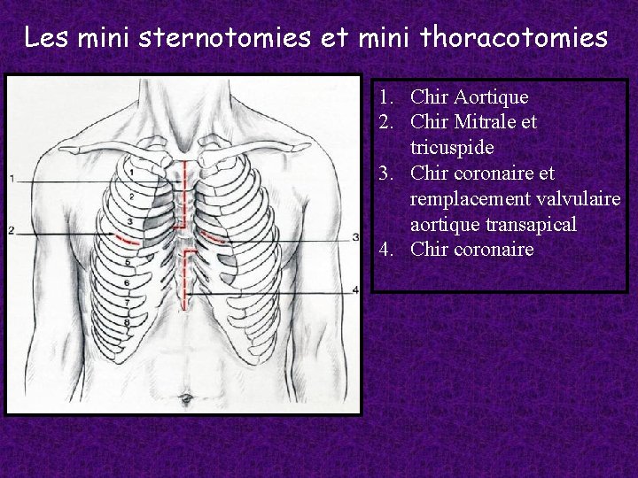 Les mini sternotomies et mini thoracotomies 1. Chir Aortique 2. Chir Mitrale et tricuspide