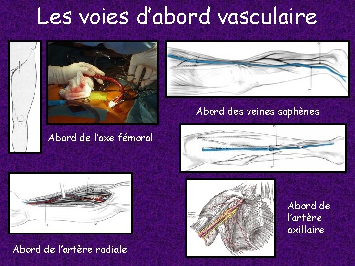 Les voies d’abord vasculaire Abord des veines saphènes Abord de l’axe fémoral Abord de