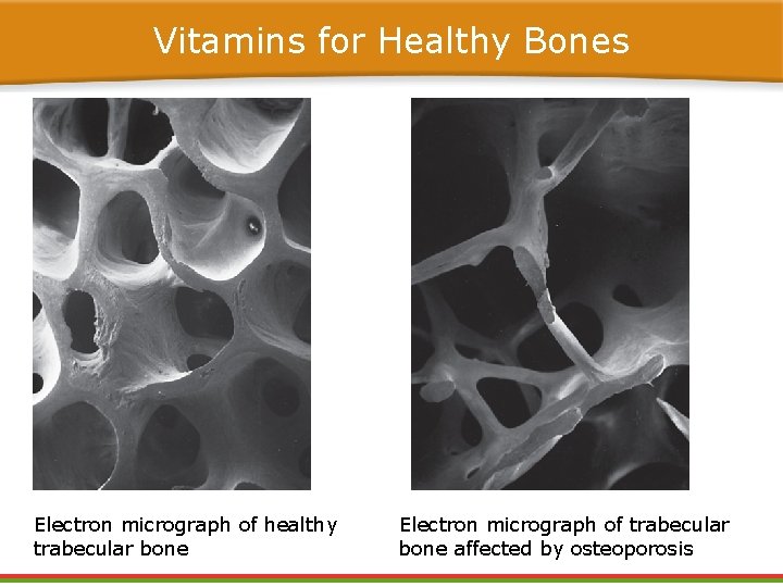 Vitamins for Healthy Bones Electron micrograph of healthy trabecular bone Electron micrograph of trabecular Vitamins for Healthy Bones Electron micrograph of healthy trabecular bone Electron micrograph of trabecular