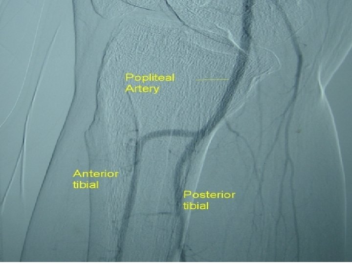 5. Popliteal artery/vein ØContinuation of the femoral artery ØBegins as the femoral artery passes 5. Popliteal artery/vein ØContinuation of the femoral artery ØBegins as the femoral artery passes