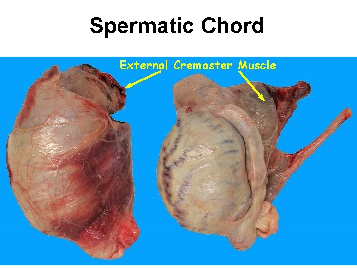 Spermatic Chord External Cremaster Muscle 