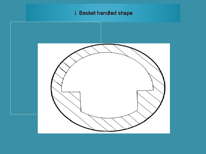 i. Basket handled shape 