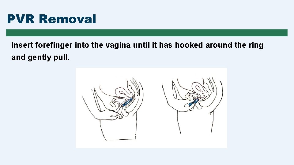 PVR Removal Insert forefinger into the vagina until it has hooked around the ring