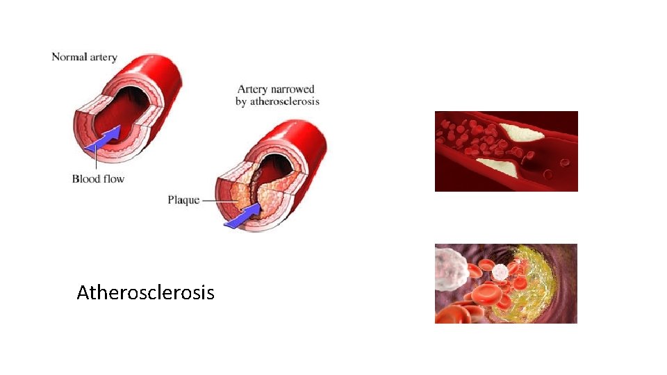 Atherosclerosis 