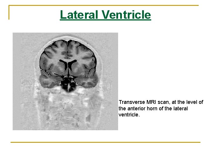 Lateral Ventricle Transverse MRI scan, at the level of the anterior horn of the