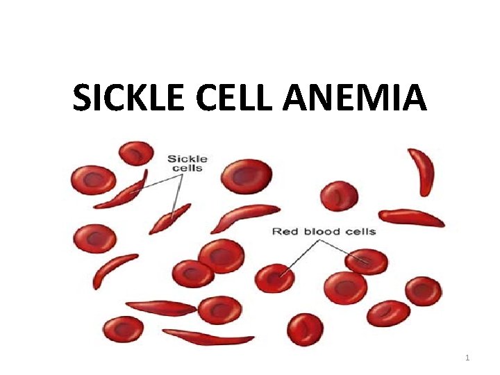 SICKLE CELL ANEMIA 1 