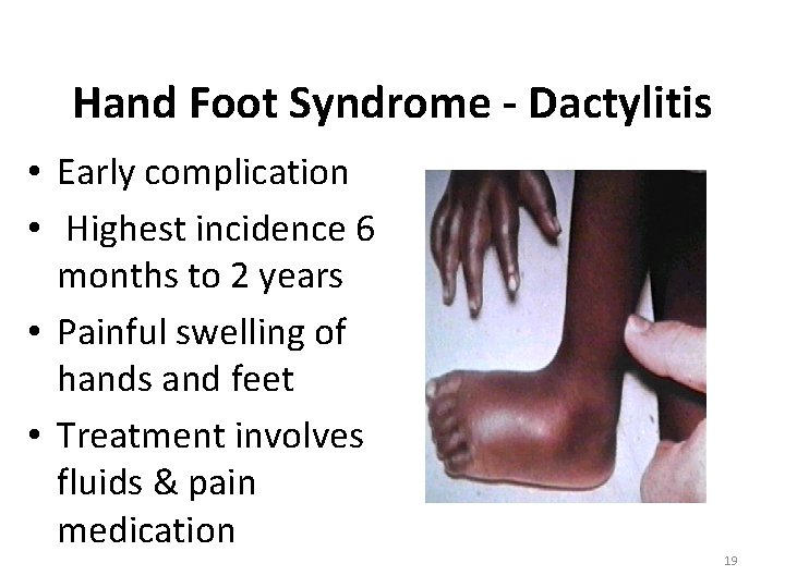 Hand Foot Syndrome - Dactylitis • Early complication • Highest incidence 6 months to