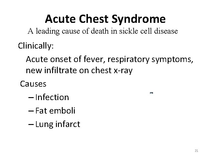 Acute Chest Syndrome A leading cause of death in sickle cell disease Clinically: Acute