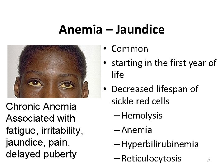 Anemia – Jaundice Chronic Anemia Associated with fatigue, irritability, jaundice, pain, delayed puberty •