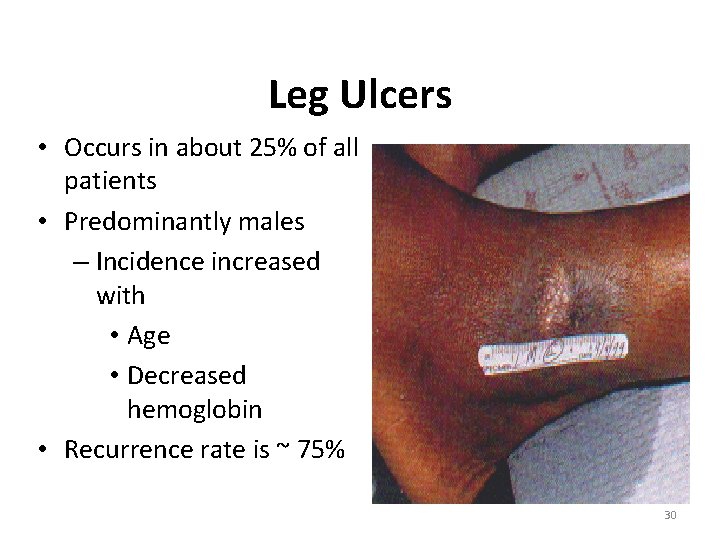 Leg Ulcers • Occurs in about 25% of all patients • Predominantly males –