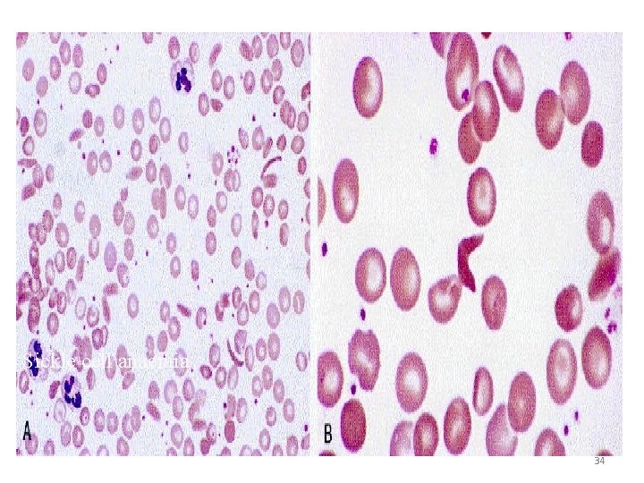 Sickle cell anaemia 34 