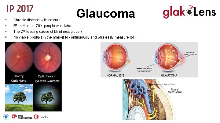 Glaucoma § Chronic disease with no cure § € 5 bn Market, 70 M