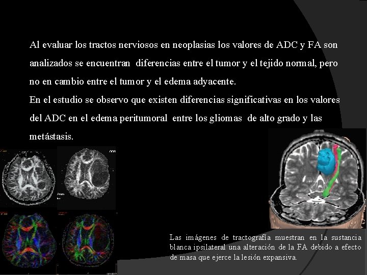 Al evaluar los tractos nerviosos en neoplasias los valores de ADC y FA son