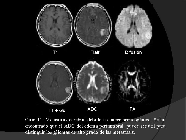 T 1 + Gd Flair ADC Difusión FA Caso 11: Metastasis cerebral debido a