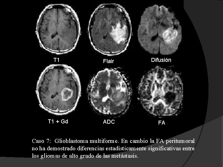 T 1 Flair Difusión T 1 + Gd ADC FA Caso 7: Glioblastoma multiforme.