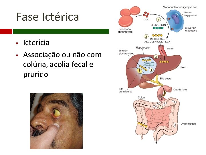 Fase Ictérica § § Icterícia Associação ou não com colúria, acolia fecal e prurido