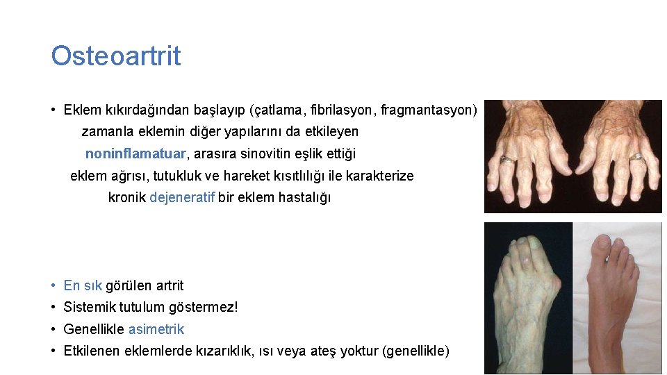 Osteoartrit • Eklem kıkırdağından başlayıp (çatlama, fibrilasyon, fragmantasyon) zamanla eklemin diğer yapılarını da etkileyen