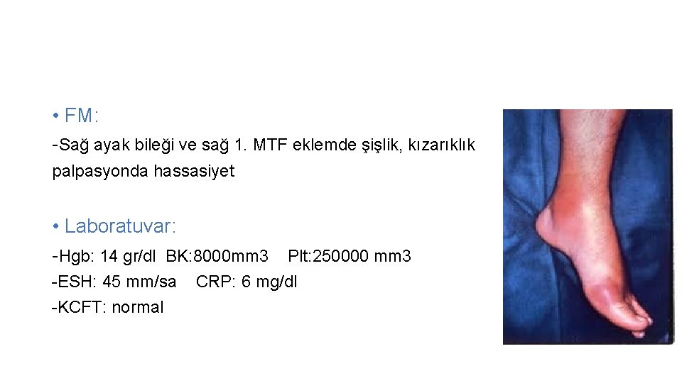  • FM: -Sağ ayak bileği ve sağ 1. MTF eklemde şişlik, kızarıklık palpasyonda