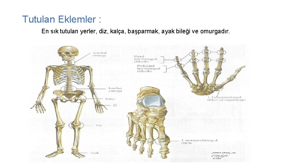 Tutulan Eklemler : En sık tutulan yerler, diz, kalça, başparmak, ayak bileği ve omurgadır.
