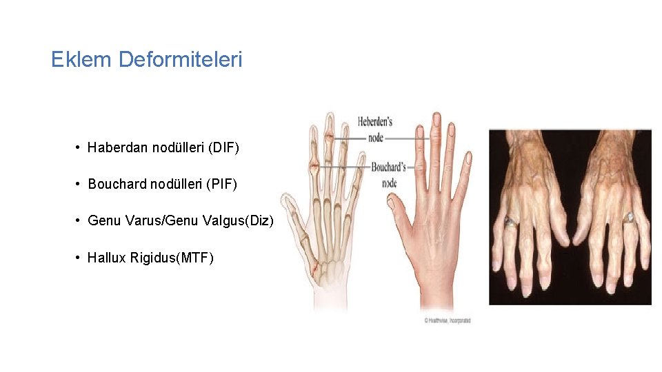 Eklem Deformiteleri • Haberdan nodülleri (DIF) • Bouchard nodülleri (PIF) • Genu Varus/Genu Valgus(Diz)