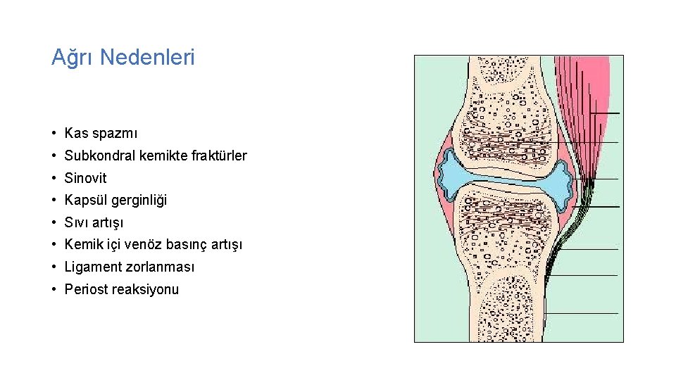 Ağrı Nedenleri • Kas spazmı • Subkondral kemikte fraktürler • Sinovit • Kapsül gerginliği