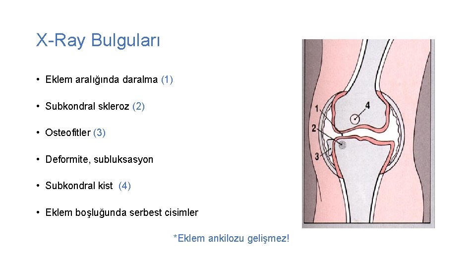X-Ray Bulguları • Eklem aralığında daralma (1) • Subkondral skleroz (2) • Osteofitler (3)