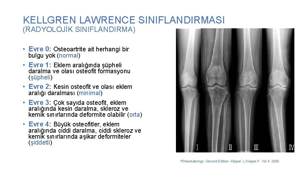 KELLGREN LAWRENCE SINIFLANDIRMASI (RADYOLOJİK SINIFLANDIRMA) • Evre 0: Osteoartrite ait herhangi bir bulgu yok