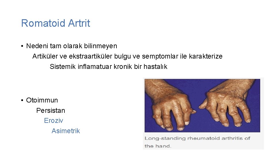 Romatoid Artrit • Nedeni tam olarak bilinmeyen Artiküler ve ekstraartiküler bulgu ve semptomlar ile