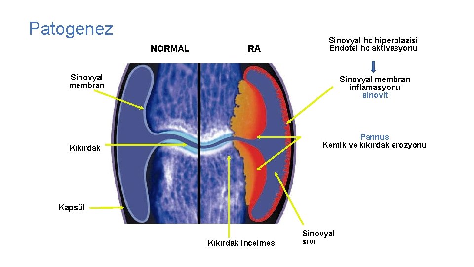 Patogenez NORMAL RA Sinovyal hc hiperplazisi Endotel hc aktivasyonu Sinovyal membran inflamasyonu sinovit Pannus