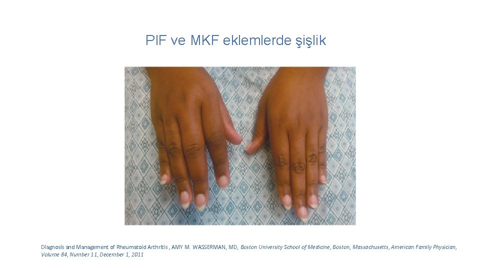  PIF ve MKF eklemlerde şişlik Diagnosis and Management of Rheumatoid Arthritis , AMY