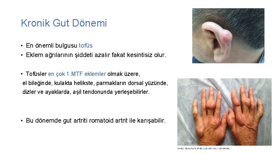 Kronik Gut Dönemi • En önemli bulgusu tofüs • Eklem ağrılarının şiddeti azalır fakat