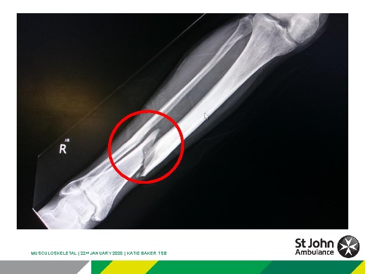 MUSCULOSKELETAL | 22 nd JANUARY 2020 | KATIE BAKER TSB 