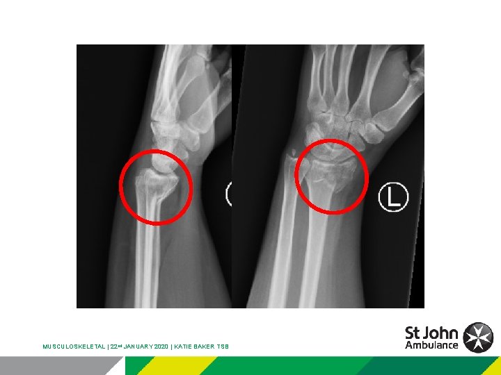 MUSCULOSKELETAL | 22 nd JANUARY 2020 | KATIE BAKER TSB 