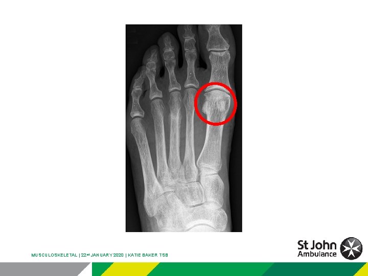 MUSCULOSKELETAL | 22 nd JANUARY 2020 | KATIE BAKER TSB 