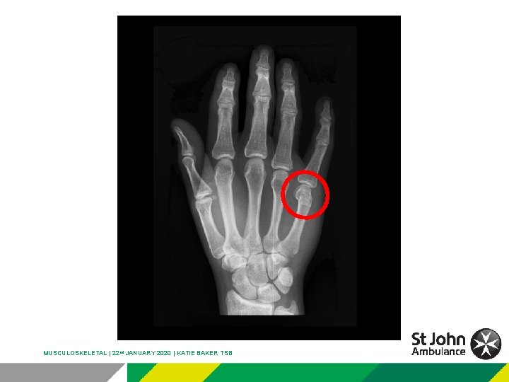 MUSCULOSKELETAL | 22 nd JANUARY 2020 | KATIE BAKER TSB 