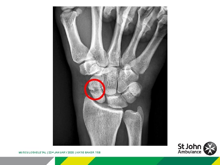 MUSCULOSKELETAL | 22 nd JANUARY 2020 | KATIE BAKER TSB 