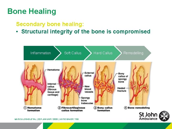 Bone Healing Secondary bone healing: • Structural integrity of the bone is compromised Inflammation