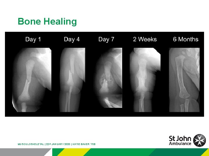Bone Healing MUSCULOSKELETAL | 22 nd JANUARY 2020 | KATIE BAKER TSB 