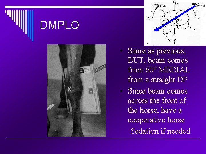 DMPLO • Same as previous, BUT, beam comes from 60° MEDIAL from a straight