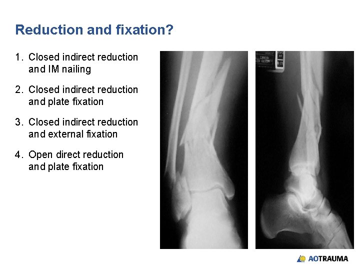 Reduction and fixation? 1. Closed indirect reduction and IM nailing 2. Closed indirect reduction