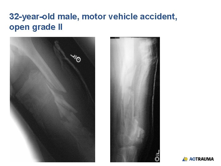 32 -year-old male, motor vehicle accident, open grade II 