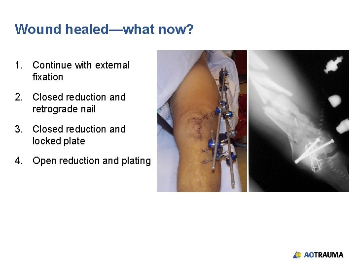 Wound healed—what now? 1. Continue with external fixation 2. Closed reduction and retrograde nail