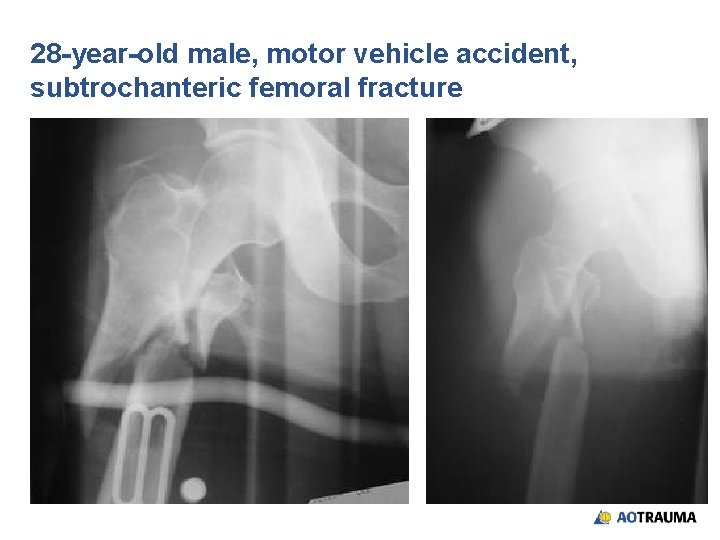 28 -year-old male, motor vehicle accident, subtrochanteric femoral fracture 