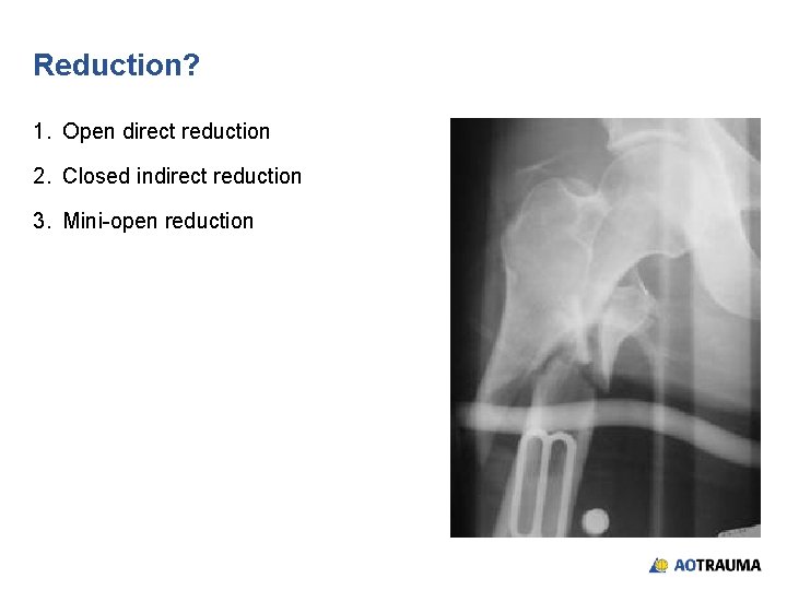 Reduction? 1. Open direct reduction 2. Closed indirect reduction 3. Mini-open reduction 