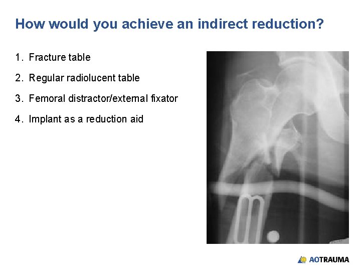 How would you achieve an indirect reduction? 1. Fracture table 2. Regular radiolucent table